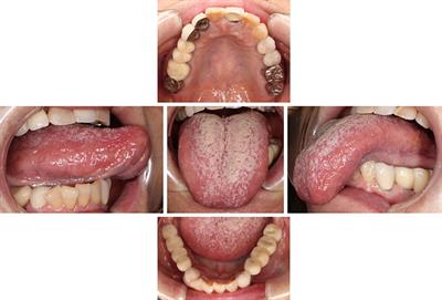 A case with burning mouth syndrome followed by dementia with Lewy bodies: a case report